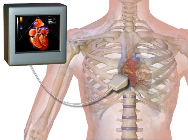 what-is-stress-echocardiography-cardiaccanvas